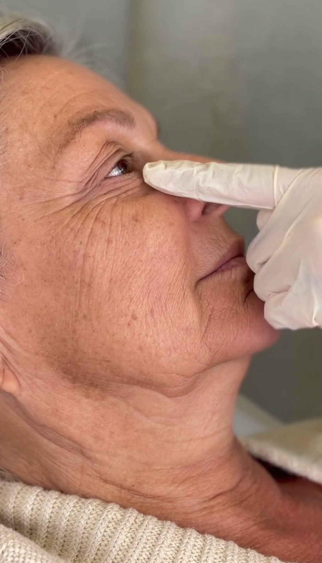 Profhilo-behandling hos Nasa Klinik